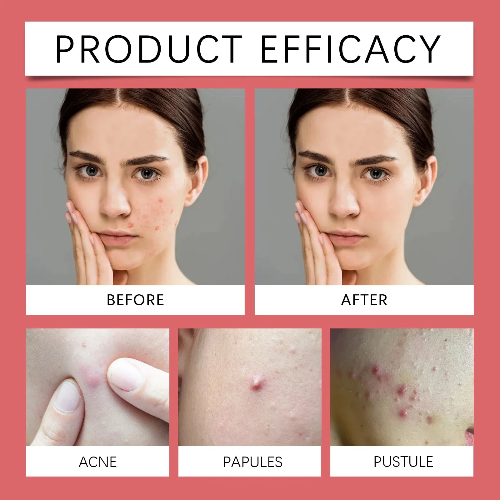 Day Night Acne Patch Set
